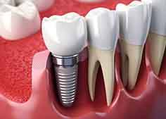 a 3D illustration of a dental implant in the jawbone