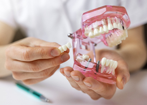 Hands holding a model mouth demonstrating sample implant bridge
