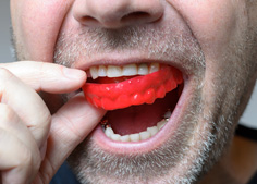 Always wear a sports mouthguard to protect your dental implants during athletic activities