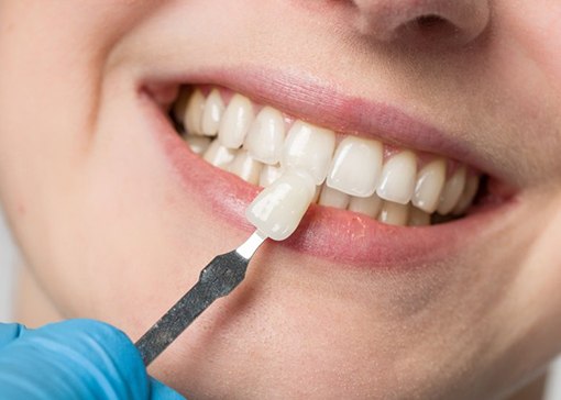 Close up of dentist comparing a dental veneer to patient’s teeth